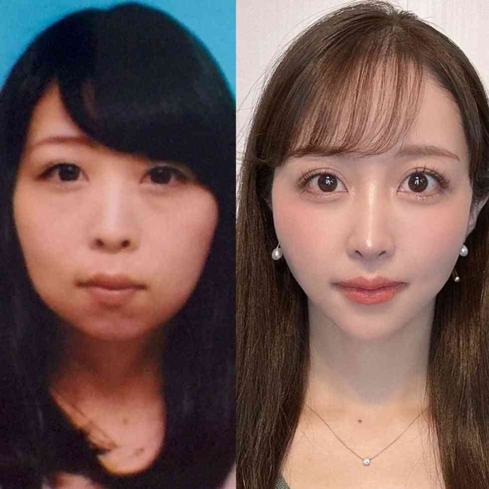 【整形美女】“お金で手に入れた見た目”はズルい?…1300万課金した女性が語る美の価値観「包帯を取っても美しい自分はいなかった」