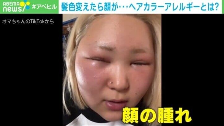 ヘアカラーで顔がパンパンに!? 「顔と頭皮、全部かゆい！」症状と対策は？