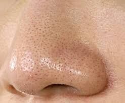 いちご鼻が治らない