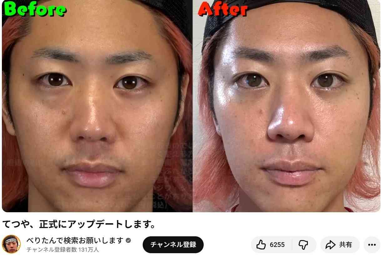 峯岸みなみ、夫・東海オンエアてつやの美容整形”を告白「こんなに変わるんだ」38万円のビフォーアフターが話題