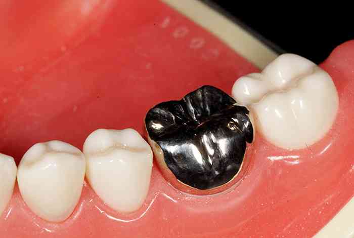 銀歯は印象がマイナス？