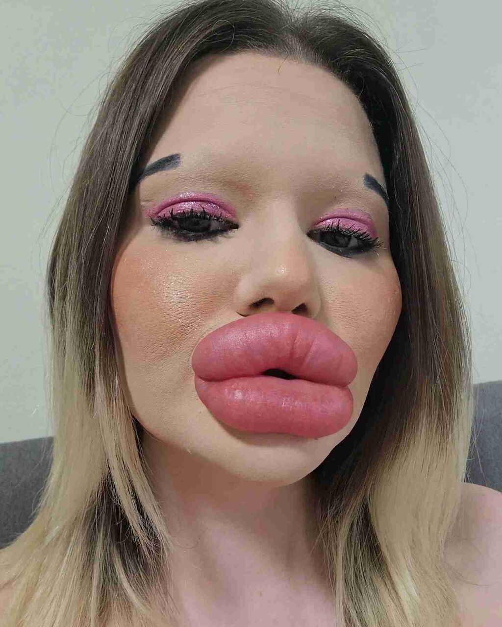 整形で“世界一大きな唇”を手に入れた女性が「醜い」「気持ち悪い」と批判されるも「次は世界一大きな頬骨がほしい」とやる気