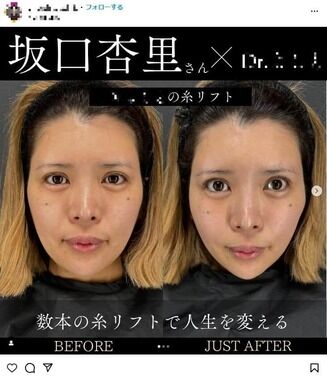 坂口杏里が糸リフト整形報告...激変ビフォーアフター　本人も仕上がり絶賛「シュッてなってる」