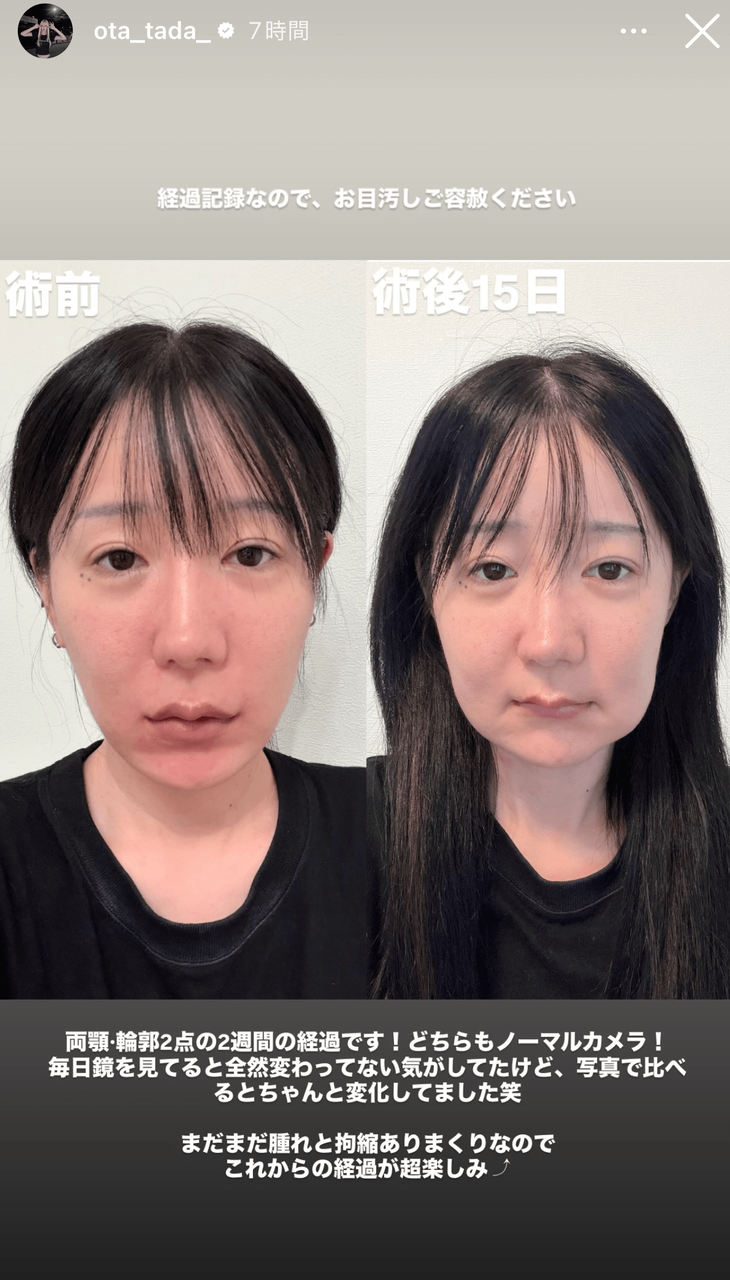 「本当に壮絶」「簡単なことじゃない」『夜ふかし』多田さん　両顎・輪郭手術の大整形後の“ビフォアアフター”にネット驚愕