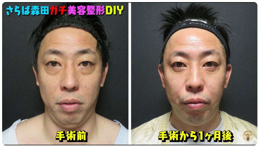 「さらば青春の光」　森田哲矢さん　美容整形手術を受けていたことを報告　昨年末に「もうここで取っちゃおうと」「年末年始はダウンタイムに」