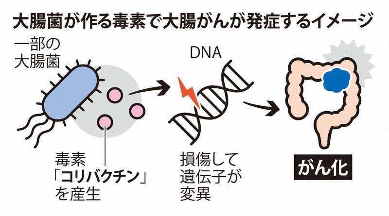 日本人の大腸がん、半数に腸内細菌が作る毒素が関与　阪大など