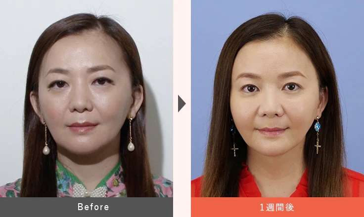 華原朋美　糸リフト整形＆脂肪注入　ビフォー・アフターに歓喜「こんなに表情変わる」体重激減で美追求