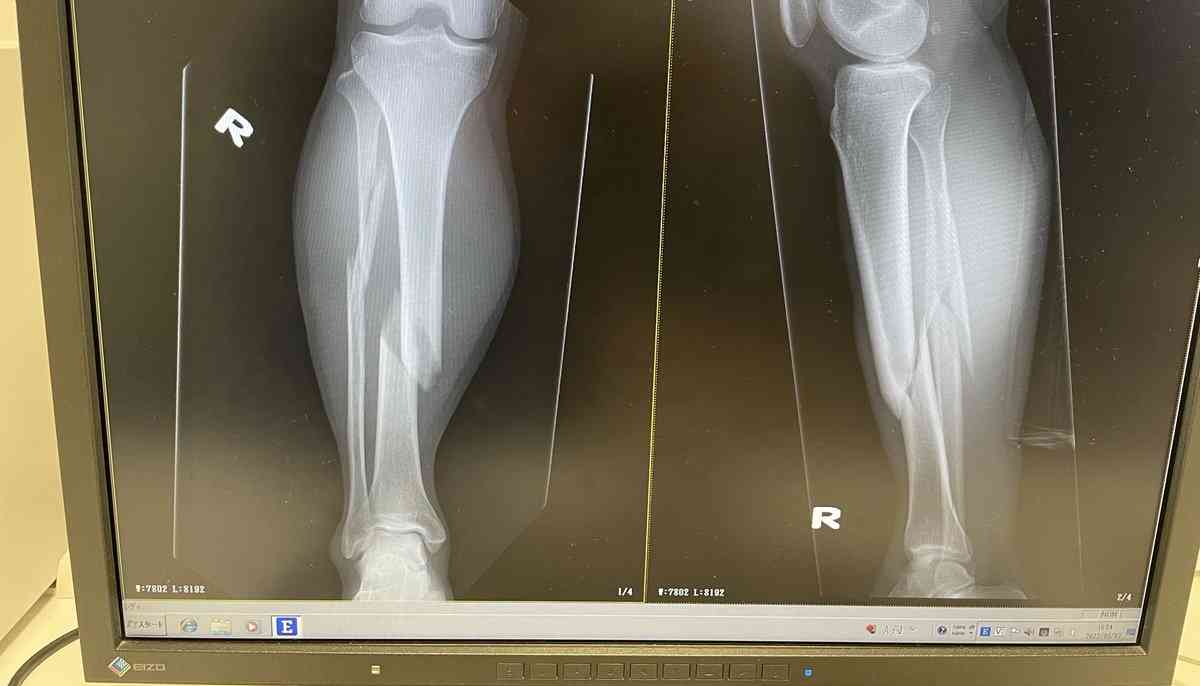 電動キックボードで全治7か月の重傷　転倒男性が語る“規制緩和”の危険性「かなり不安定な乗り物」