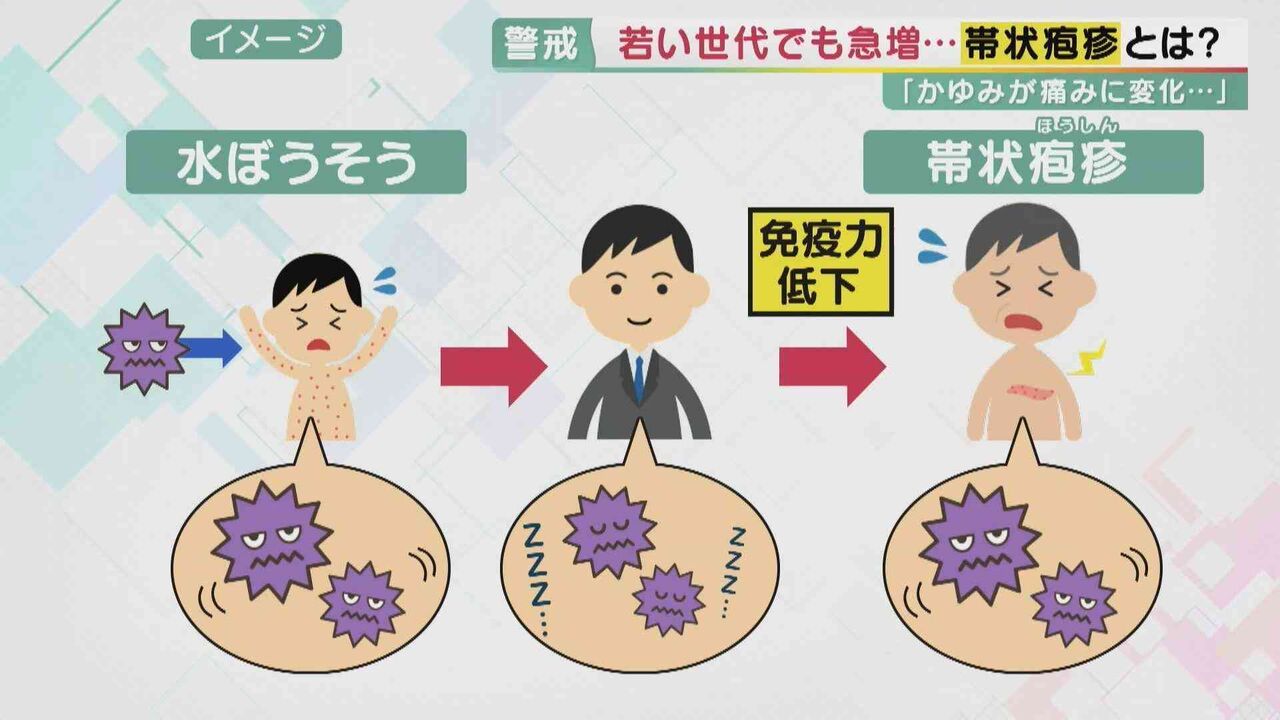 若い世代でも患者が急増「帯状疱疹」　気づきにくく治療が遅れ重症化するケースも　“免疫機能”を高めることが予防のポイント