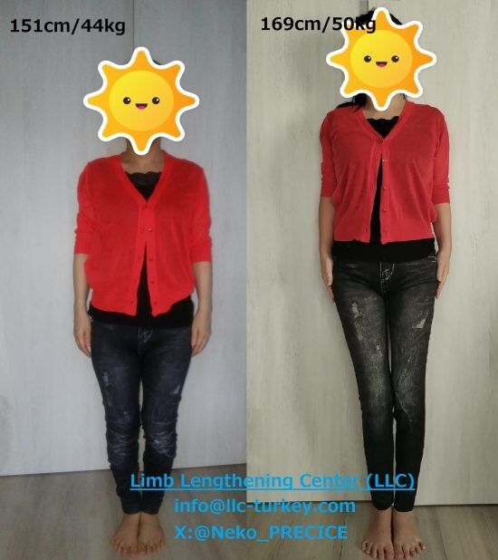 身長を18cm“買った”55歳女性。2100万円かけて海外で「骨延長」手術したワケ