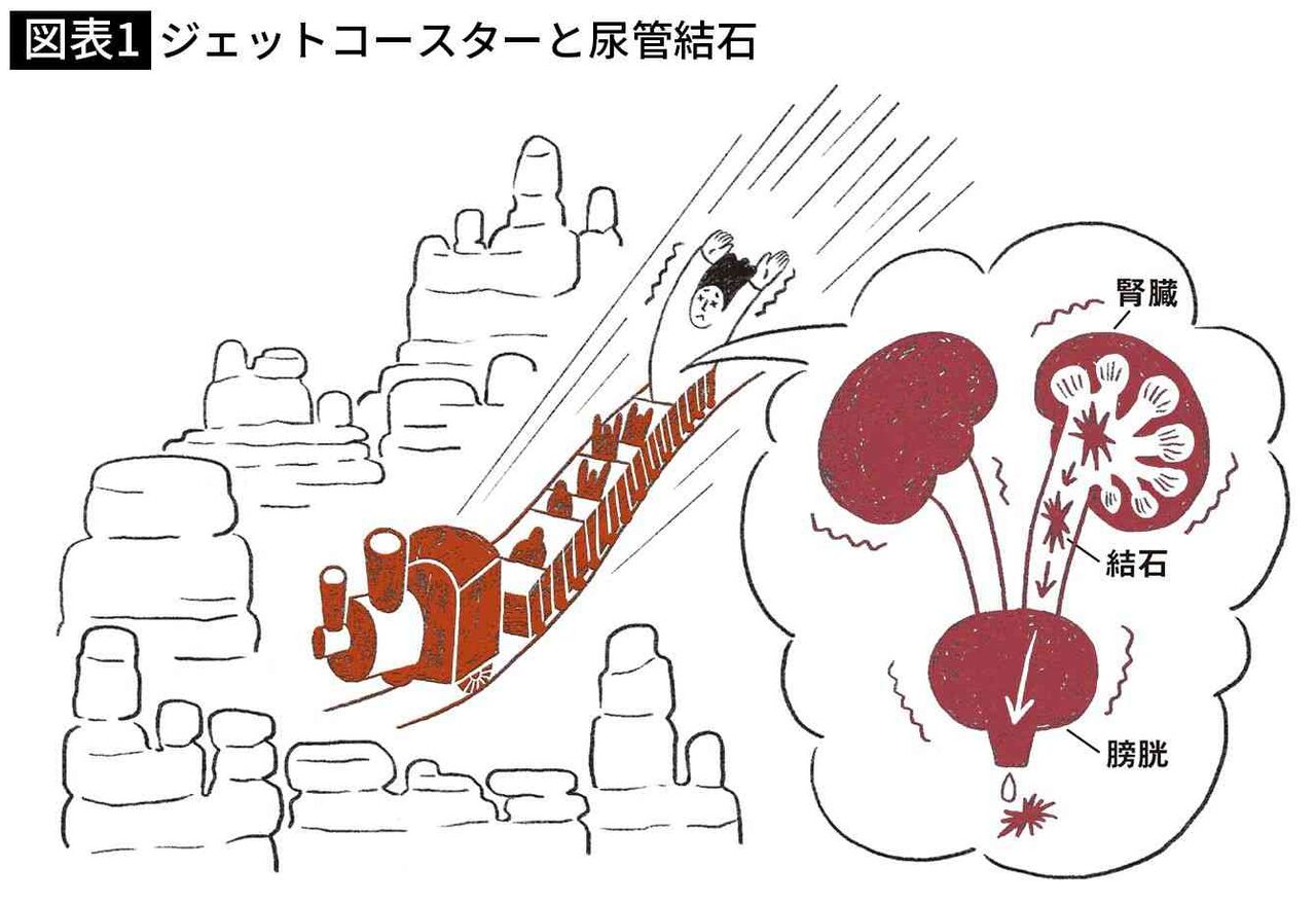 ビッグサンダーマウンテンに乗って尿管結石が出た人続出…実証研究で排石率は先頭席12.5%､最後部席63.9%