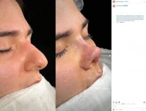 鼻先を上向きにするトルコの形成手術に「ぶた鼻」「スケートボードランプ」と辛辣な声