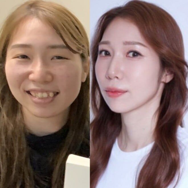 推しから確定ペンサをもらったら整形終了、“選ばれない自分”に終止符を打つため顔面課金した女性「自分にゴールをつけてあげたかった」