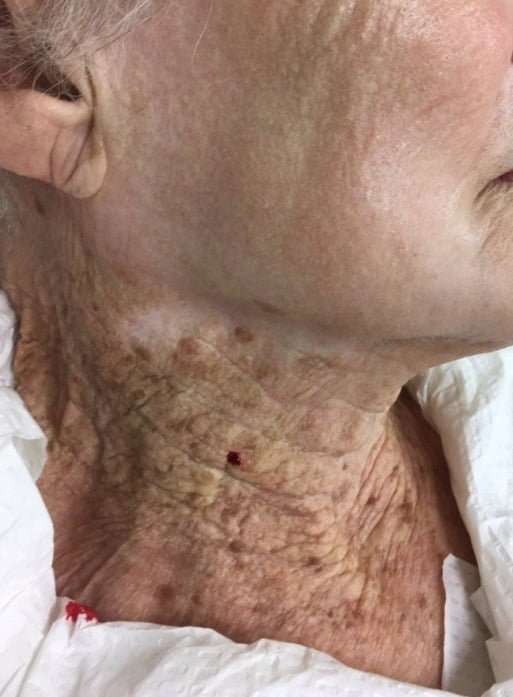 40年間、顔だけ日焼け止めを塗った…92歳のおばあちゃんの首の写真に衝撃