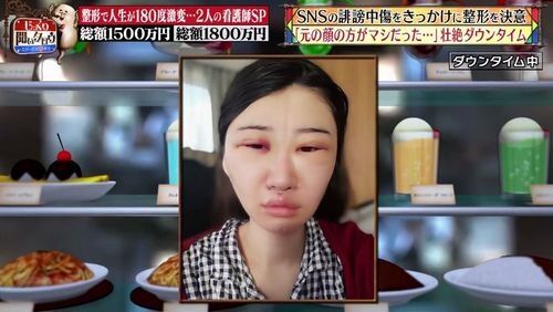 “整形総額10年間で1500万”看護師兼インフルエンサー、後悔している施術・韓国での過酷体験語る「精神的に辛くなった」