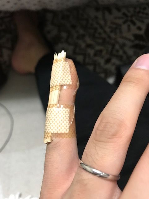 小指が第1関節だけ曲がったままなんだけど ポコポコ日記 小指が第1関節だけ曲がったままなんだけど ポコポコ日記