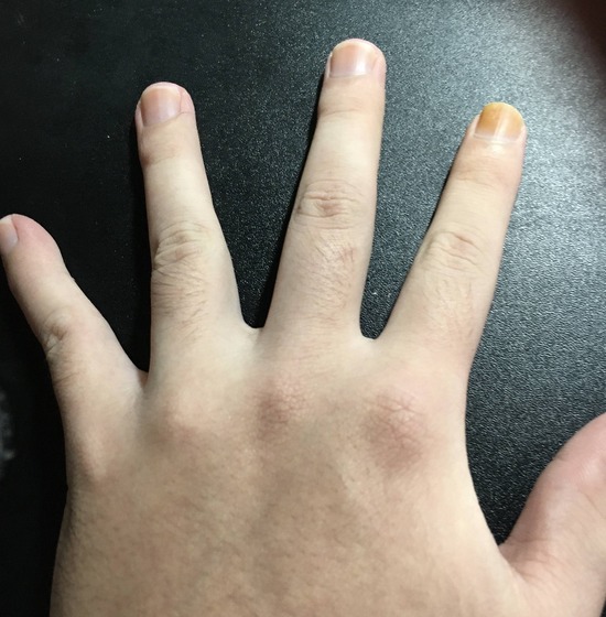【画像】ワイの爪あきらかに異常ｗｗｗ