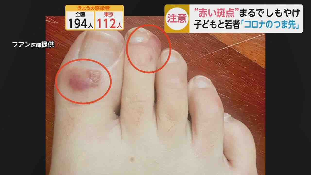 30 40代の新型コロナ患者が脳梗塞に しもやけ状になる コロナのつま先 に注意 再生医療情報 30 40代の新型コロナ患者が脳梗塞に しもやけ状になる コロナのつま先 に注意 再生医療情報