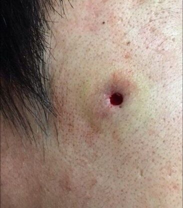 グロ注意 粉瘤の手術跡wwwwwwwwwwww トム速報