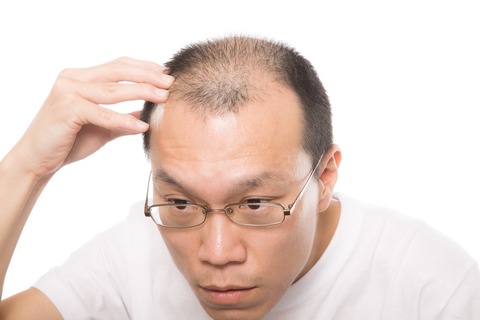 悲報 ワイ若ハゲ いよいよやばい トム速報