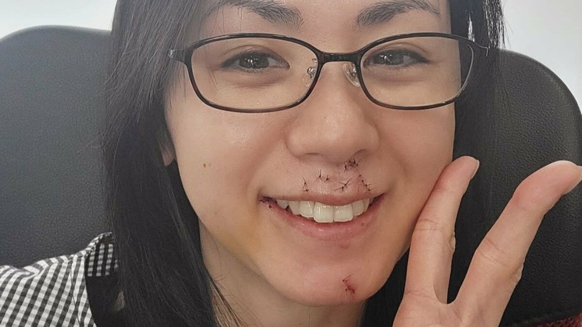 【閲覧注意】ちょwww小島可奈子さんが犬に噛まれた結果wwww これは草生えるわwww