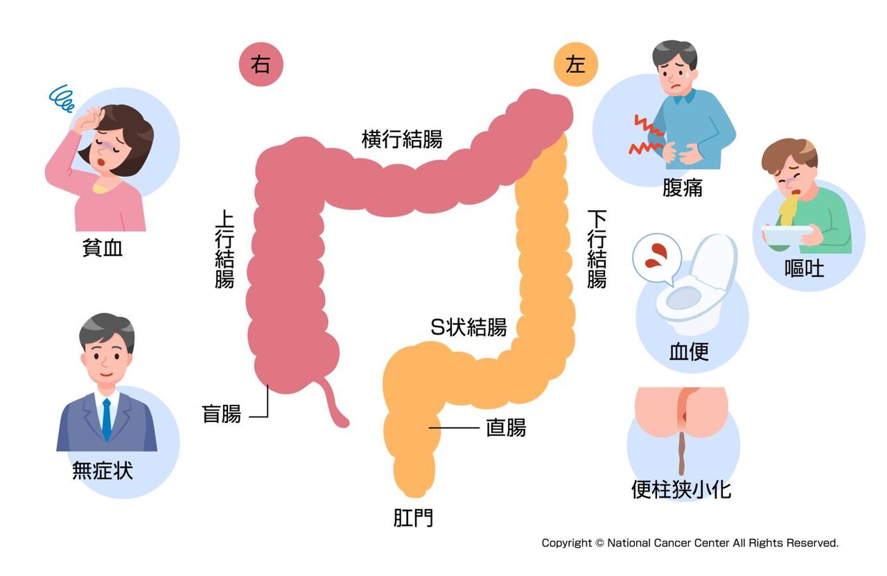 【医療】若者の間で大腸がん・・・脂っこい、味が濃いものを好むので 大腸がん発病率が高いのも頷けます。