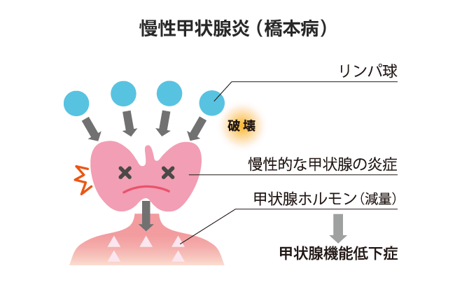 「甲状腺機能低下症の症状とは？橋本病を理解するための基礎知識」