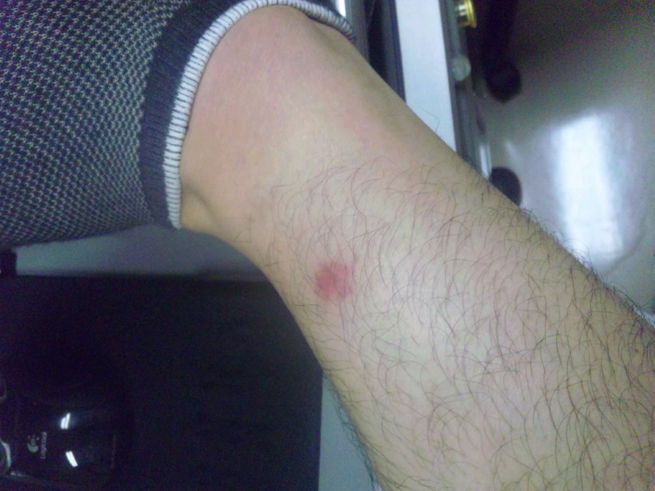 臨床推論道場」第1弾-特に既往の無い30代男性の、虫刺され後の激しい