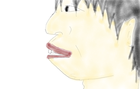 アデノイド1
