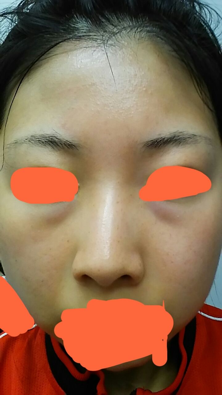 39日目 ハイドロキノンで シミを跡形もなくするまで