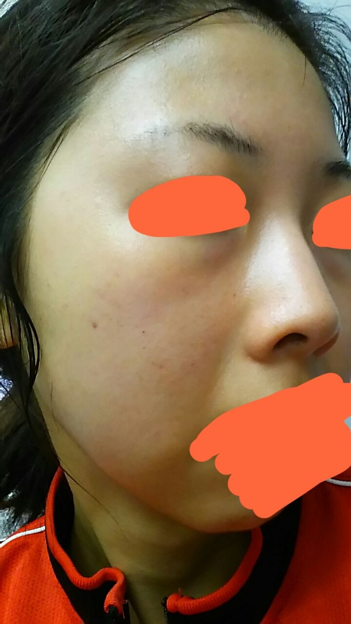 39日目 ハイドロキノンで シミを跡形もなくするまで