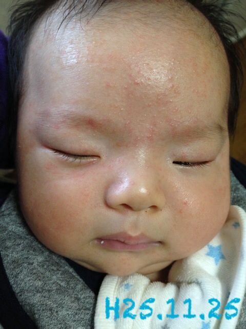 乳児湿疹 はちこblog 乳児湿疹 はちこblog
