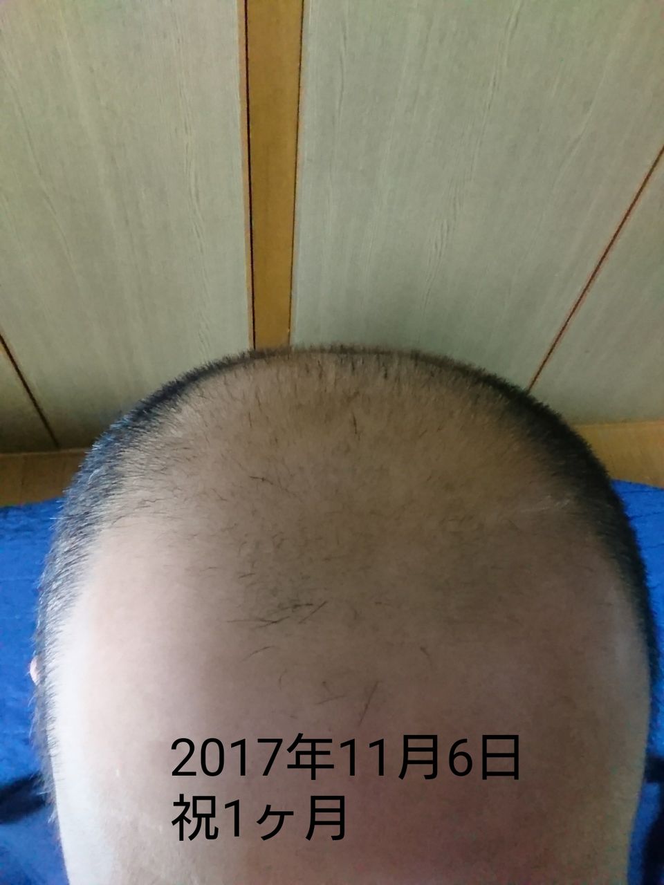 ミノタブ フィンペシア 32日目 祝1ヶ月 ハゲ坊主のブログ ミノキシジルタブレット フィンペシアorデュタス 亜鉛 L リジン Aga