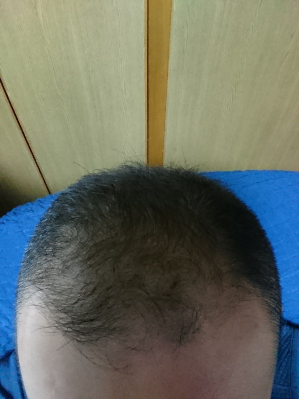 ハゲ坊主のブログ ミノキシジルタブレット＋フィンペシアorデ ...