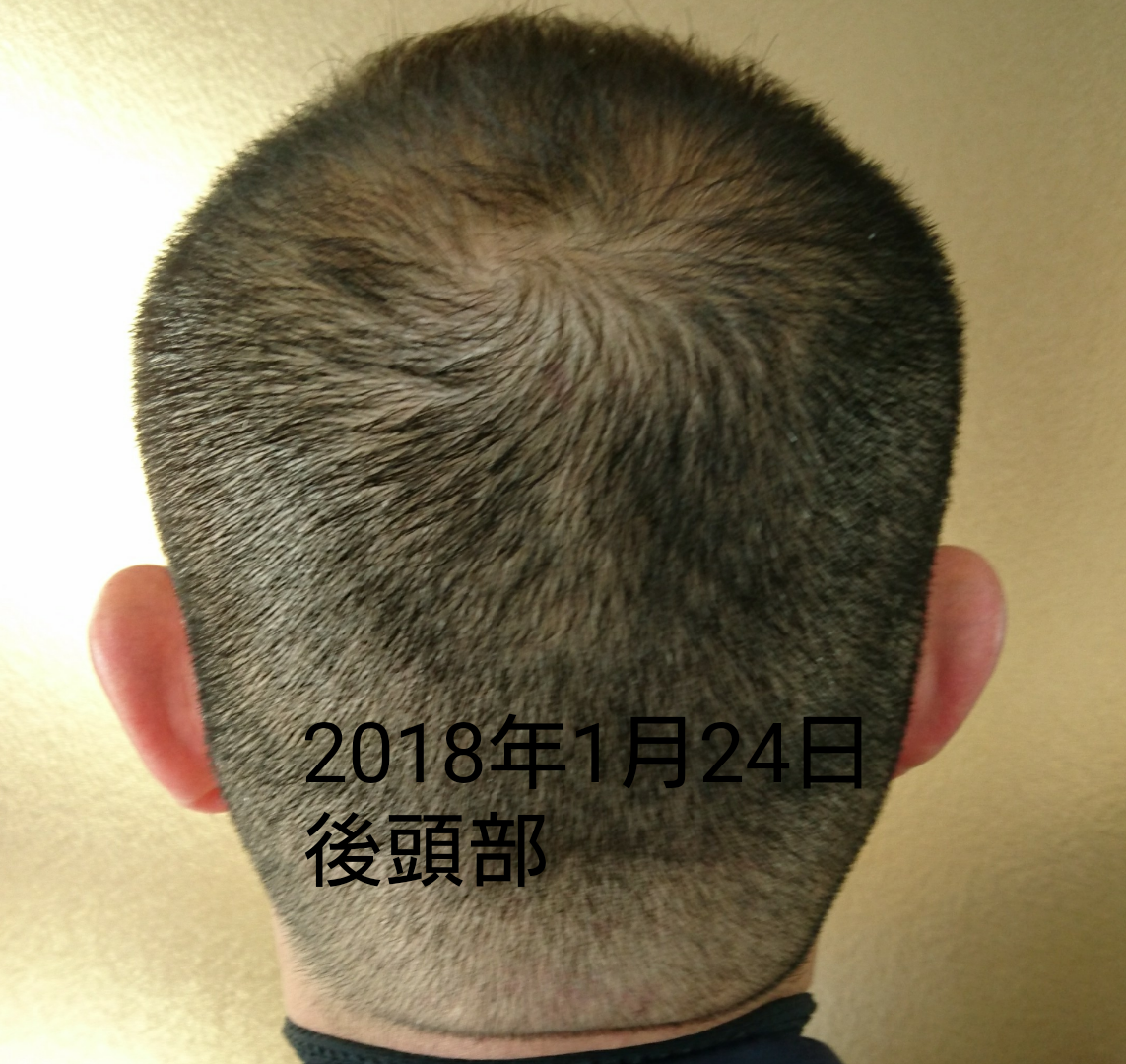 ミノタブ フィンペシア 併用 172日目 抜け毛継続中24日 後頭部の比較 ハゲ坊主のブログ ミノキシジルタブレット フィンペシアorデュタス 亜鉛 L リジン Aga ミノタブ フィンペシア 併用 172日目 抜け毛継続中24日 後頭部の比較 ハゲ坊主のブログ ミノキシジルタブレット フィンペシアorデュタス 亜鉛 L リジン Aga