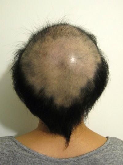 訃報 ワイのおでこ 指4本分 ハゲろぐ 訃報 ワイのおでこ 指4本分 ハゲろぐ