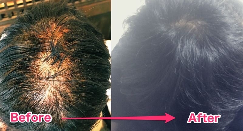 痩せたら生えた よしもと芸人がダイエット成功でハゲ克服 ハゲルヤ ハゲと向き合うウェブマガジン