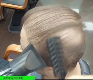 【神業】薄毛対策はスーパーミリオンヘアーのスプレーだった