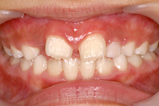 上の前歯が変なとこに生えてきました 歯医者さんの子育て