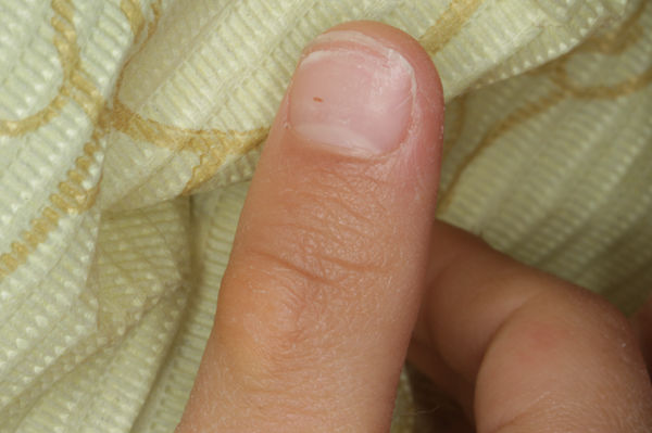 指しゃぶりの吸いだこ 歯医者さんの子育て 指しゃぶりの吸いだこ 歯医者さんの子育て