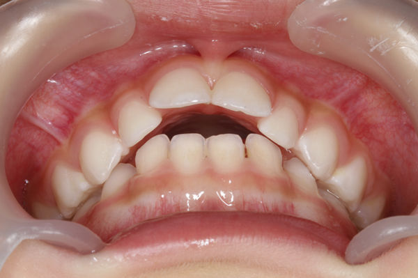 指しゃぶりの吸いだこ 歯医者さんの子育て 指しゃぶりの吸いだこ 歯医者さんの子育て