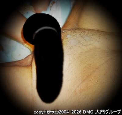 種汁を押し出すパンチングフィスト【DMG大門 Essence\'s Ｓ ブログ】