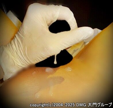 バルーン拡張で暴発する種汁【DMG大門 Essence\'s Ｓ ブログ】