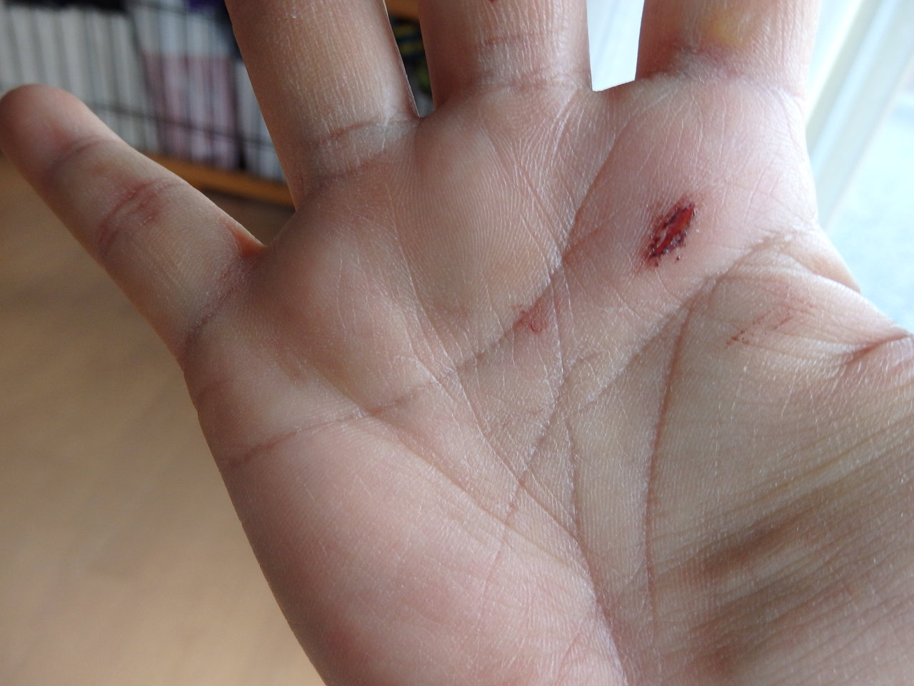 冷えピタの誤飲にご注意 ｈ ｌ ｎｉｃｏそしてｂ ｌ