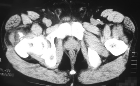 冠状断 - コピー