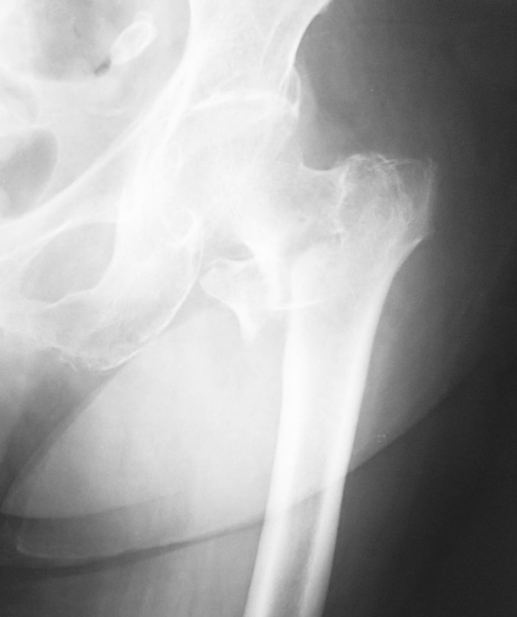 大腿骨々幹部骨折（だいたいこつこつかんぶこっせつ） | 福岡の弁護士による後遺障害・等級認定サポート