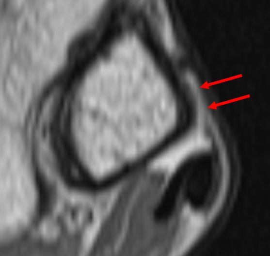 腓骨筋腱脱臼のmri所見 整形外科医のブログ 腓骨筋腱脱臼のmri所見 整形外科医のブログ