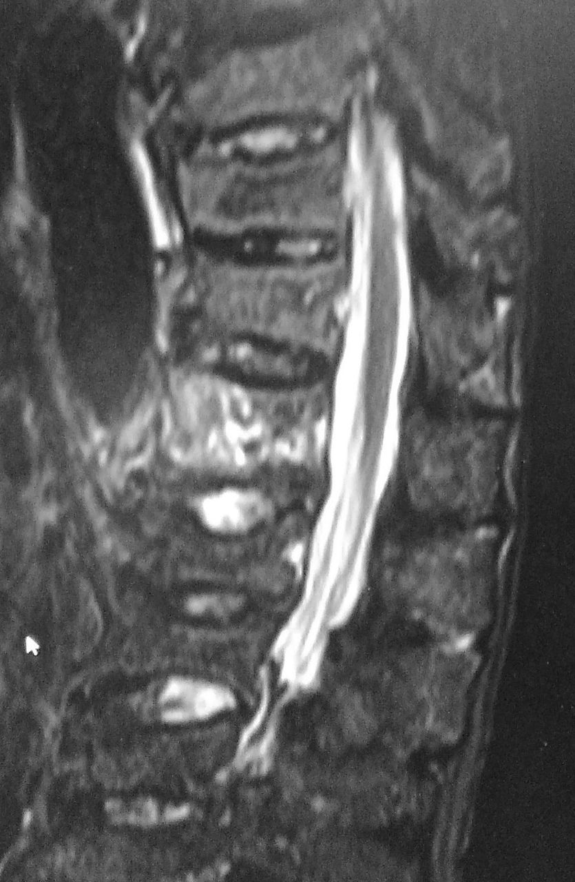 チャンス骨折を見逃すな 整形外科医のブログ