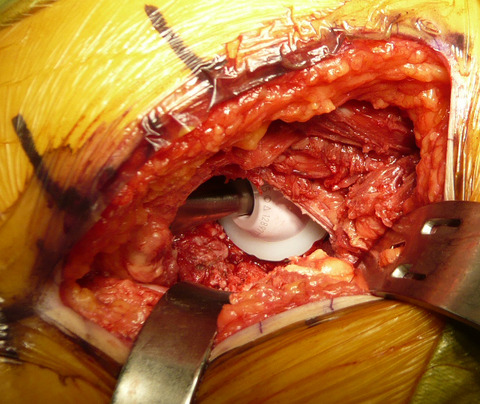 内閉鎖筋温存 - コピー