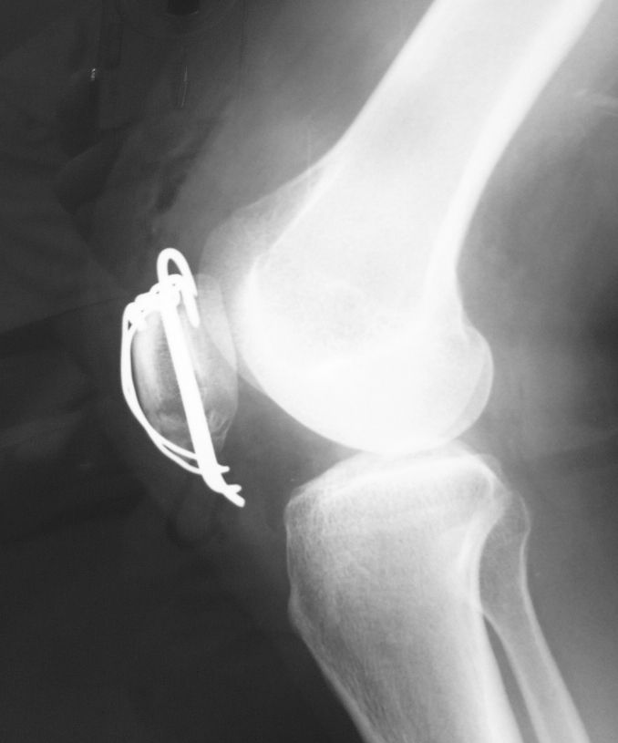 膝蓋骨下極骨折はヒヤヒヤです 整形外科医のブログ